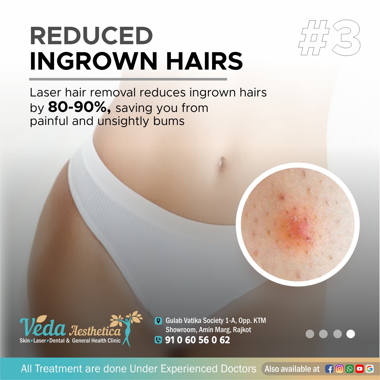 Reduced Ingrown Hair by Laser Treatment