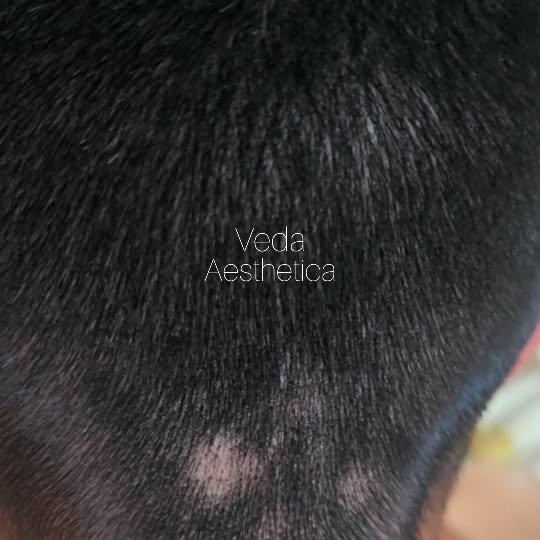 Alopecia Areata Treatment